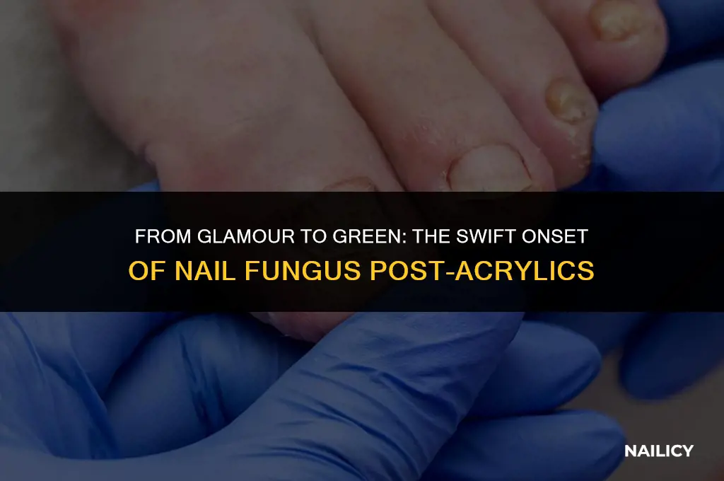 how fast can you get nail fungus after acrylics