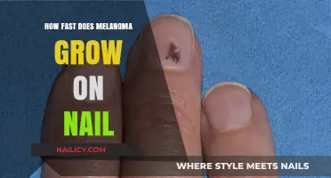 Melanoma Growth on Nails: How Fast Does It Spread?