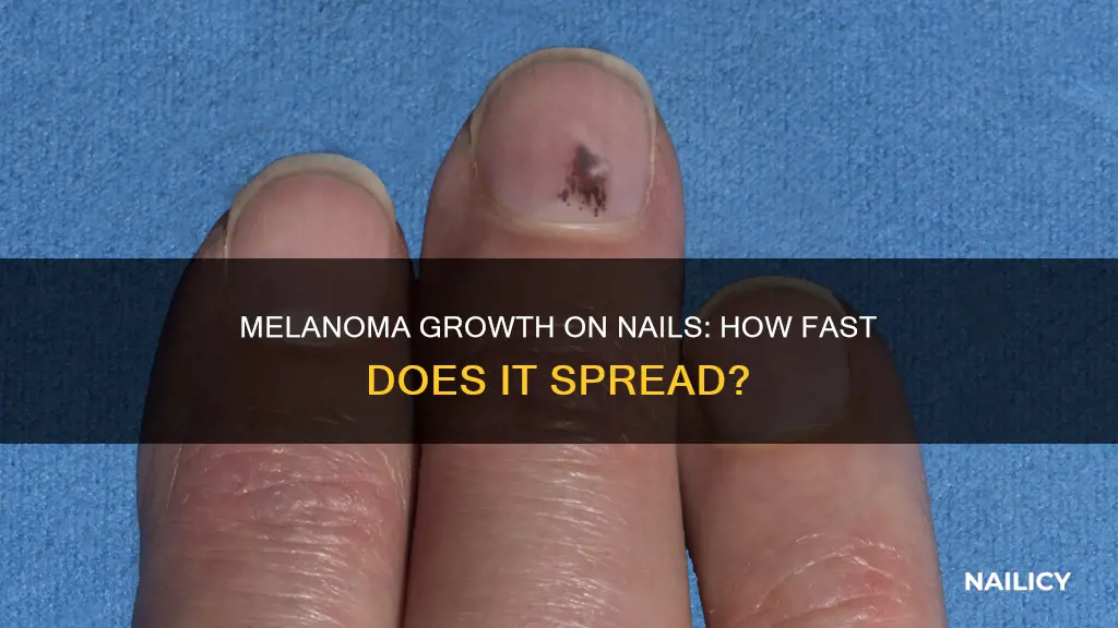 how fast does melanoma grow on nail