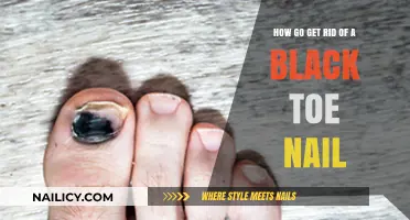 Effective Remedies to Eliminate Black Toenails: A Comprehensive Guide