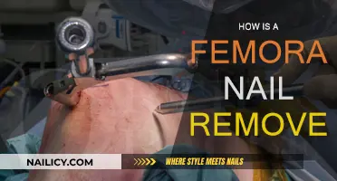 Femoral Nail Removal: What's the Procedure?