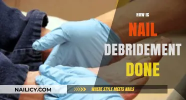 Understanding Nail Debridement: A Step-by-Step Procedure Guide