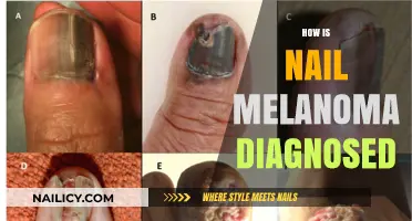 Diagnosing Nail Melanoma: Key Steps and Early Detection Methods