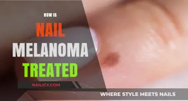 Treating Nail Melanoma: Effective Options and What to Expect