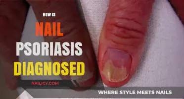 Diagnosing Nail Psoriasis: Symptoms, Tests, and Expert Evaluation Explained