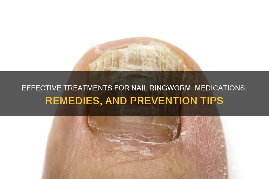 how is ringworm of the nails treated