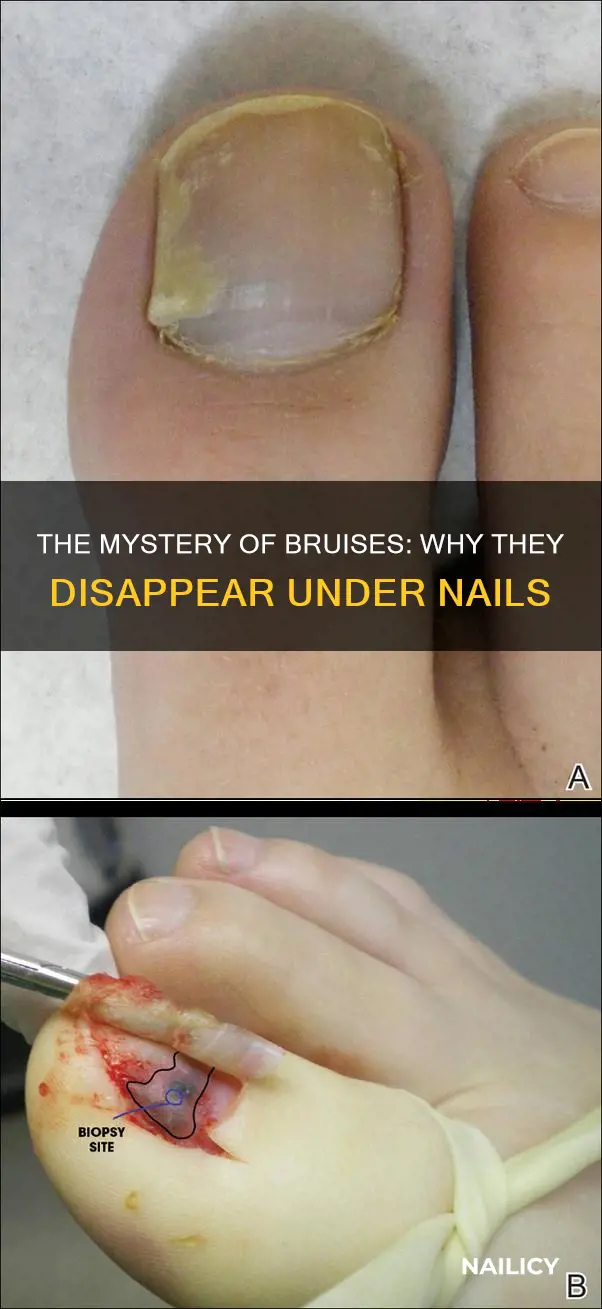 how lkng dies a bruise stay under finger nail