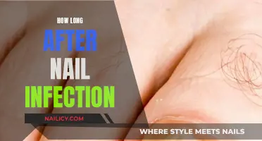 Battling Nail Infections: Recovery Timeline and Treatment Options