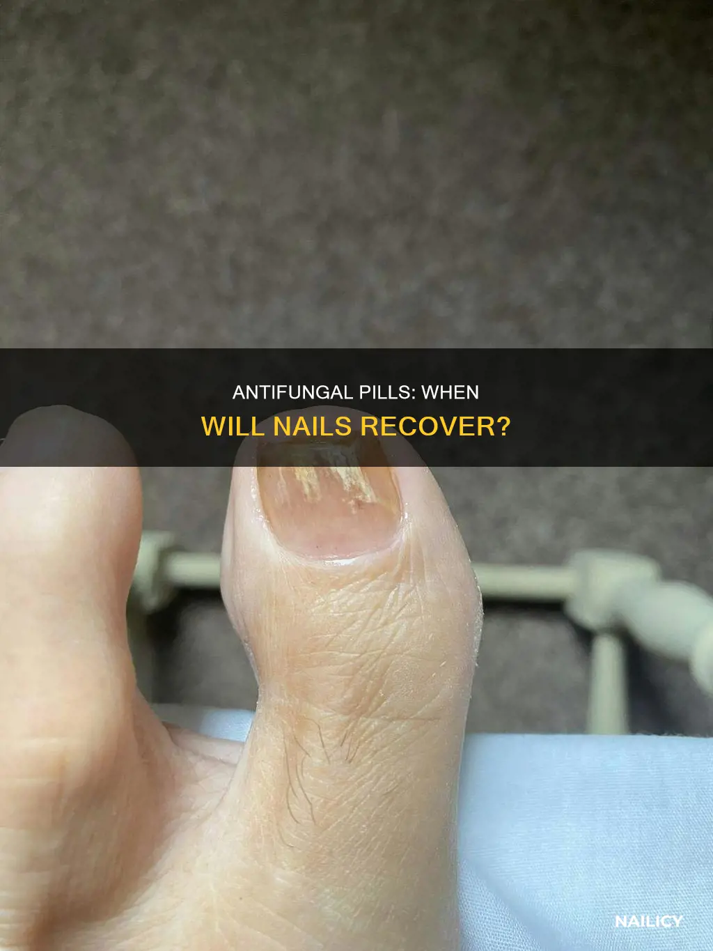 how long after taking antifungal pills do nails clear up