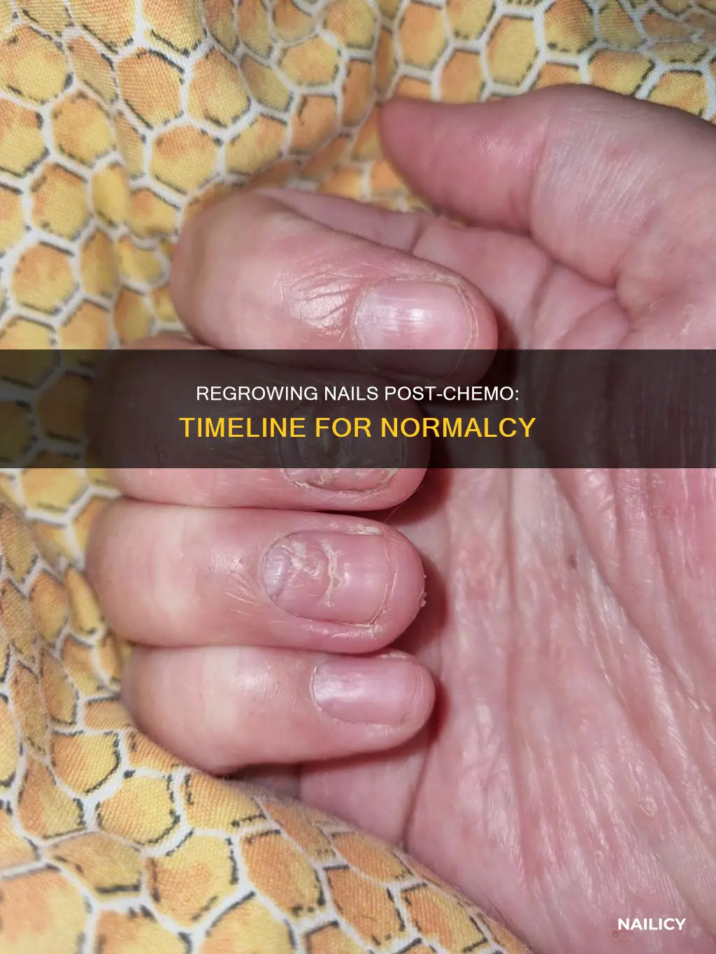 how long before finger nails normal post chemo
