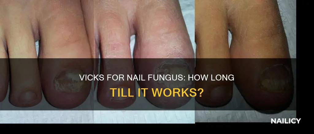 how long before vicks starts working on nail fungus