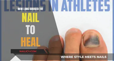 Toe Nail Healing: Understanding Bruise Recovery Time
