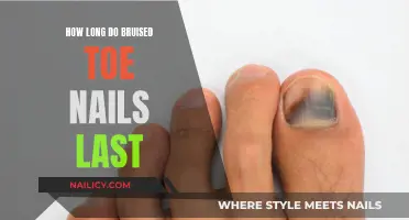 Toe Nail Bruises: Healing Time and Treatment
