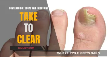 Fungal Nail Infections: Clearing Time and Treatment