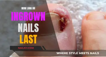 Ingrown Nails: How Long Does the Pain Last?