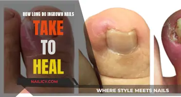 Ingrown Nails: Healing Time and Treatment Options