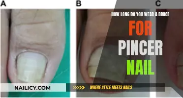 Pincer Nail Brace Treatment: How Long Does It Take?