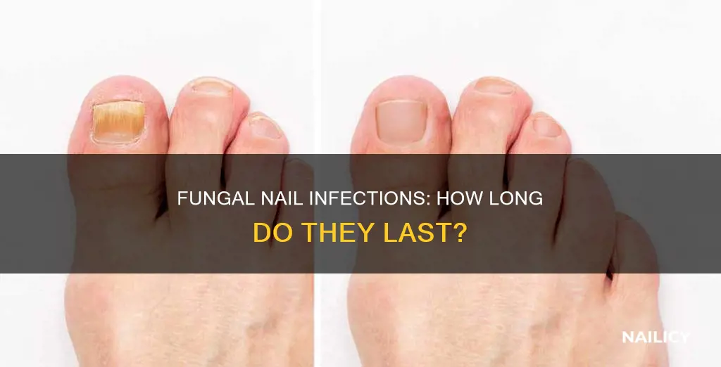how long does a fungal nail infection last
