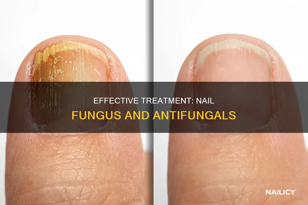 how long does antifungal for nails take