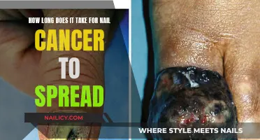 Nail Cancer: Understanding Progression and Metastasis