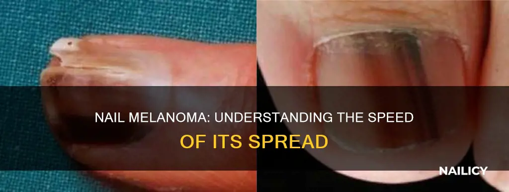 how long does it take for nail melanoma to spread