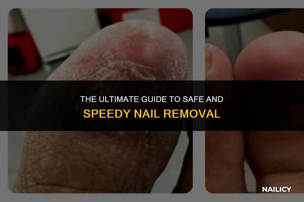 how long does it take to get nails removed
