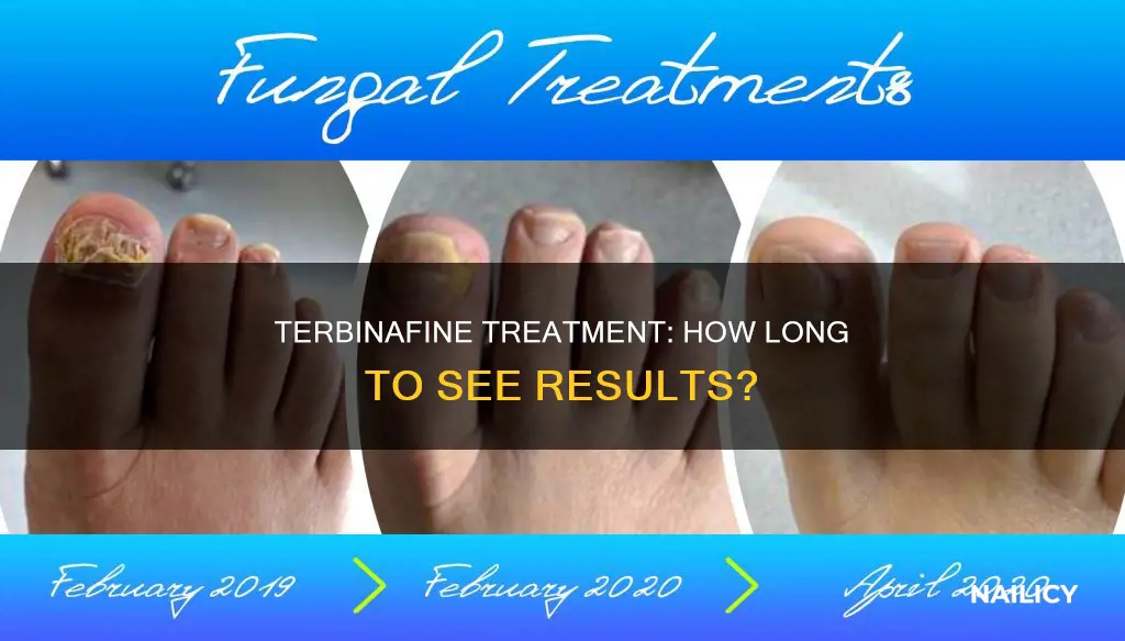 how long does terbinafine take to work for nail fungus