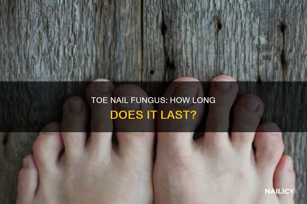 how long does toe nail fungus last