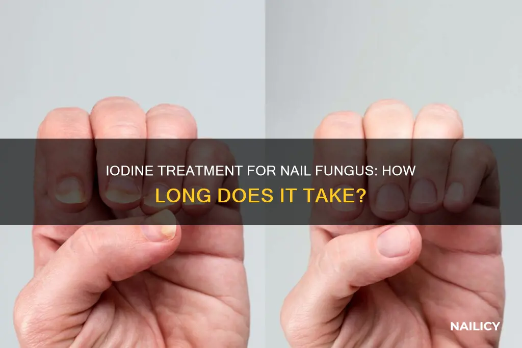 how long for iodine to kill nail fungus