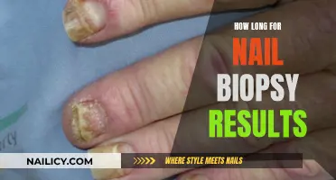 Awaiting Nail Biopsy Results: How Long Till Answers?