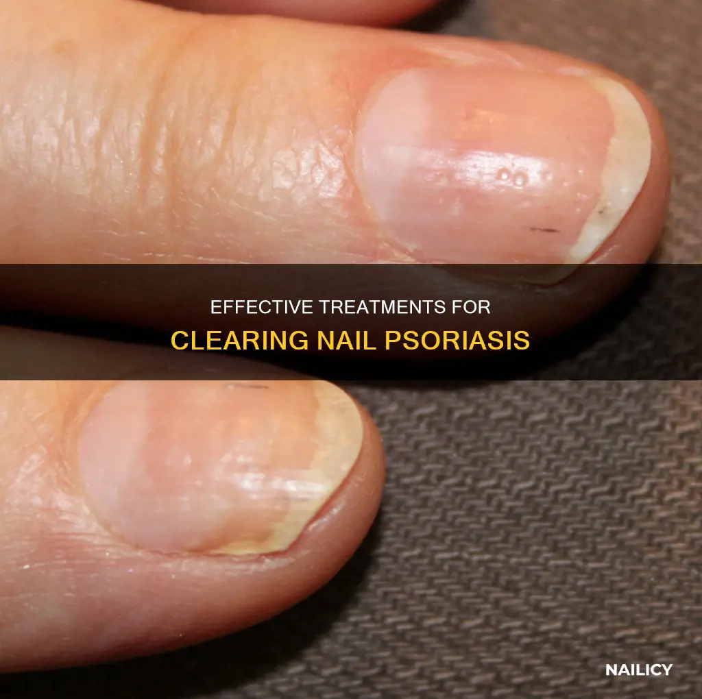 how long for nail psoriasis to clear up