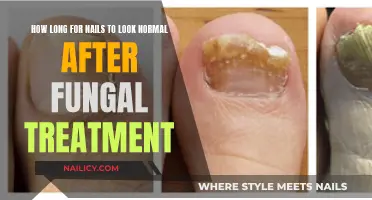Effective Nail Fungus Treatment: How Long for Results?