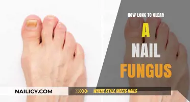 Eradicate Nail Fungus: A Timeline for Treatment