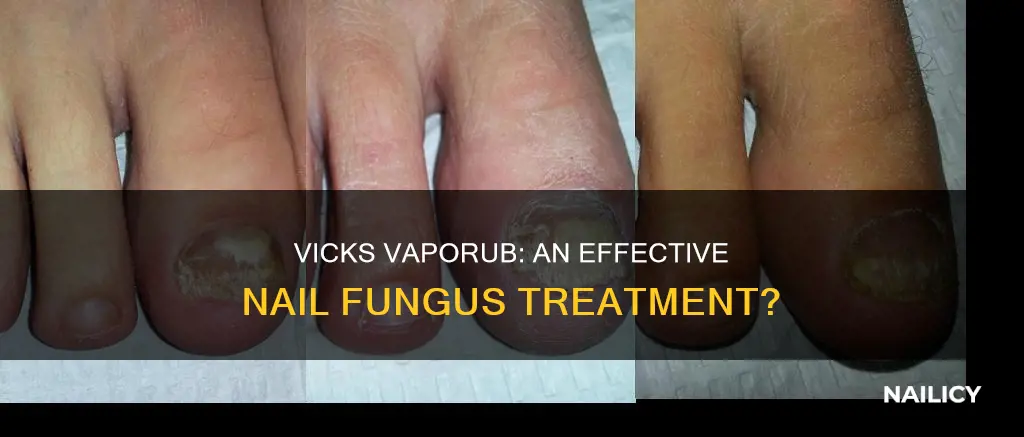 how long to cure nail fungus with vicks