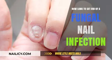 Treating Fungal Nail Infections: A Comprehensive Guide to Recovery Time