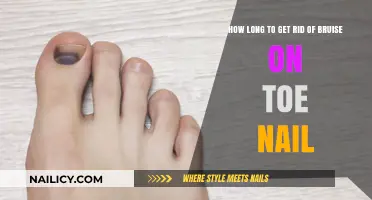Treating Toenail Bruises: A Comprehensive Guide to Faster Healing