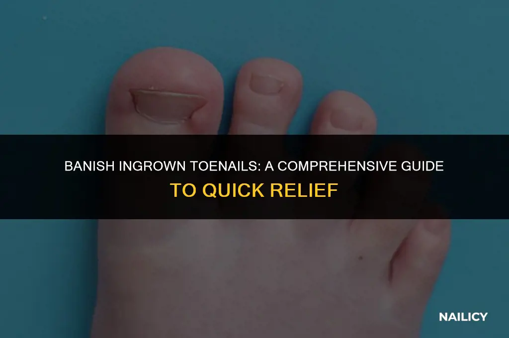 how long to get rid of ingrown toe nail