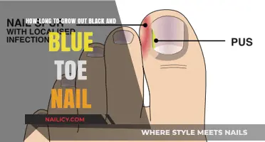 Black and Blue Toenail Recovery: Time to Heal