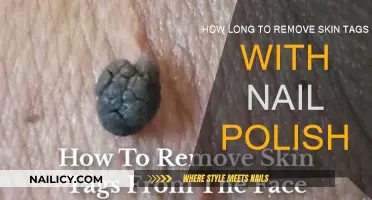 Effective Skin Tag Removal: Nail Polish Treatment Duration