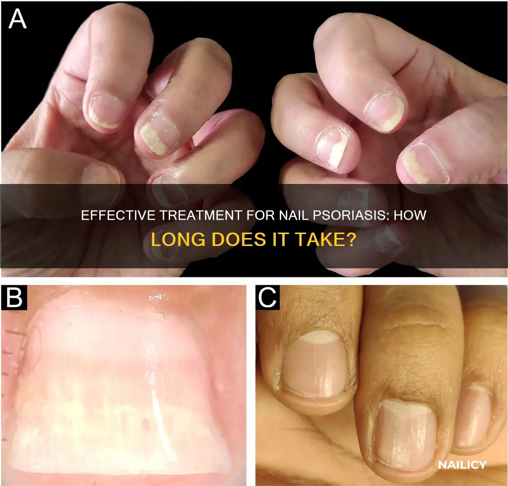 how long to treat nail psoriasis