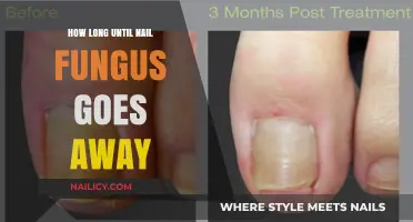 Effective Treatment for Nail Fungus: How Long Does It Take?