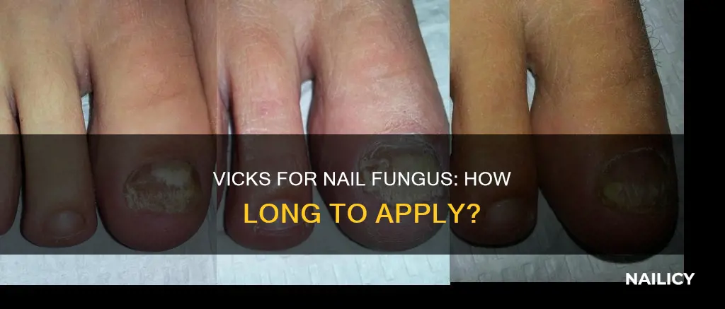 how long vicks for nail fungus