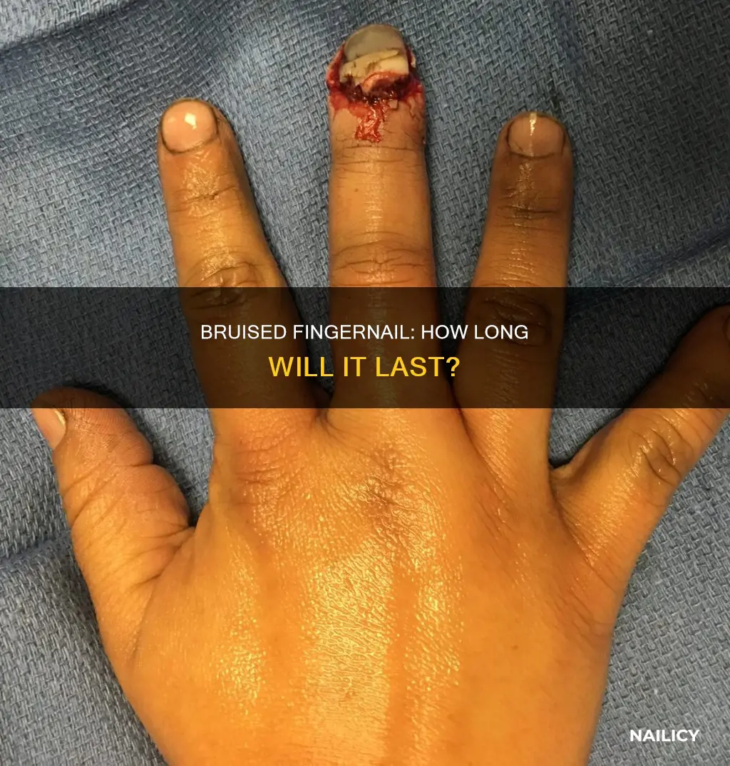 how long will a bruised finger nail last