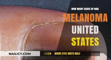 Nail Melanoma Cases in the United States: Current Statistics