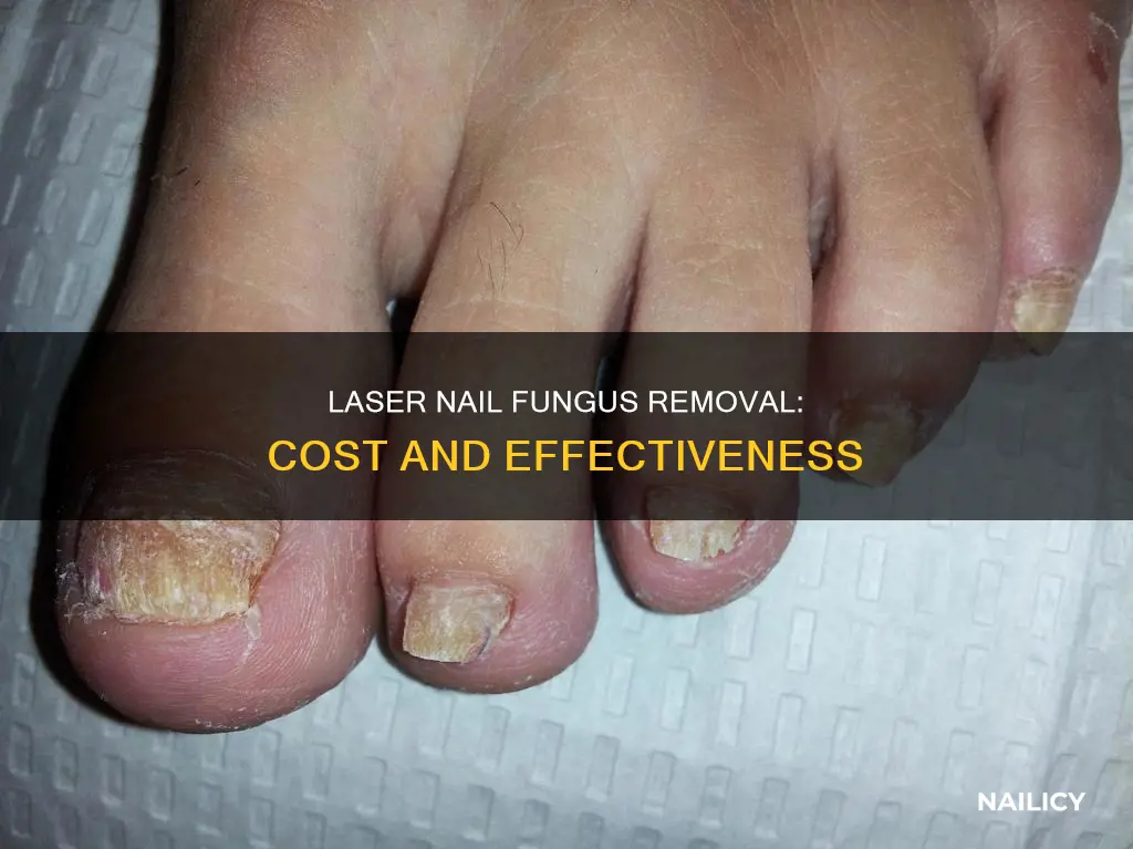 how much does laser nail fungus removal cost
