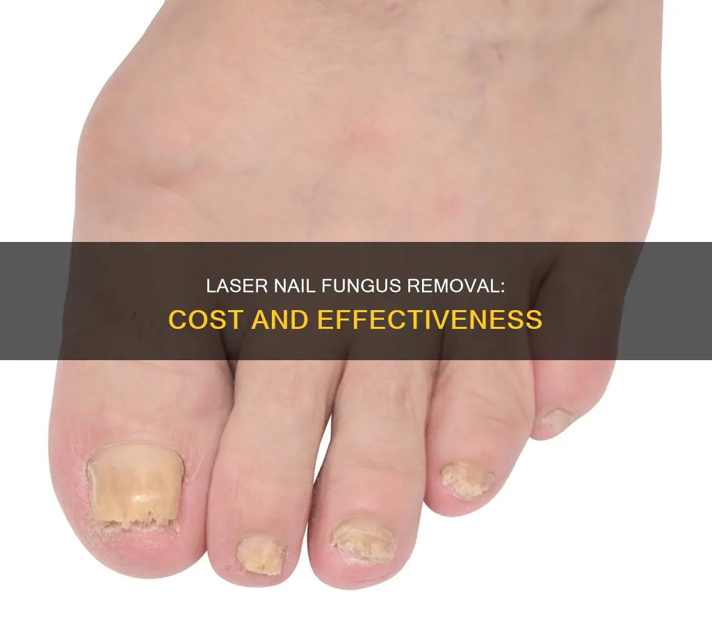 how much is laser nail fungus removal