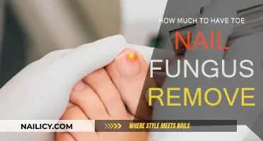 Toe Nail Fungus Removal: Cost and Treatment Options