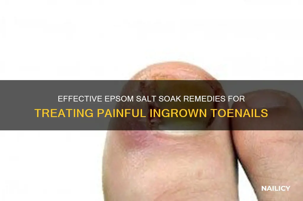 how muxh epsom aalt for an ingrown nail
