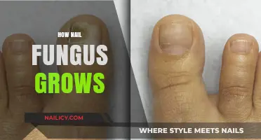 Nail Fungus: How It Grows and Spreads