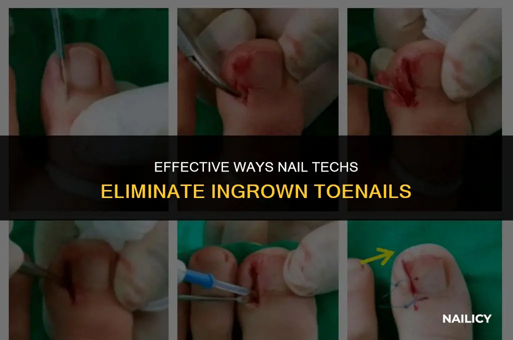 how nail techs get rid of ingrown toenails